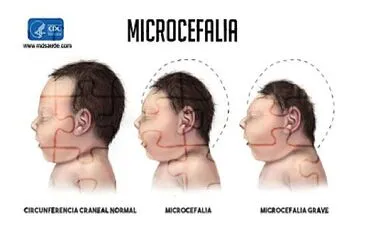 Microcefalia. jigsaw puzzle